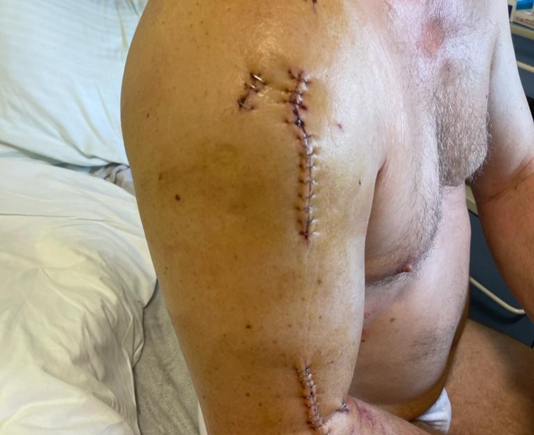 EKSKLUZIVNE FOTOGRAFIJE Naš najaktivniji saborski zastupnik ima četverostruki prijelom: “Ostao bih bez ruke da nisam u formi…”